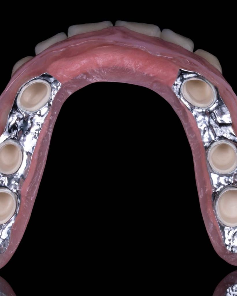 Implantatgetragene Prothetik